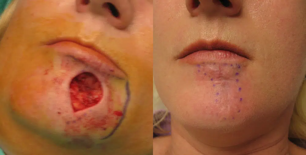 reconstruction before and after photo by chicago aesthetics surgery & med spa in chicago, il