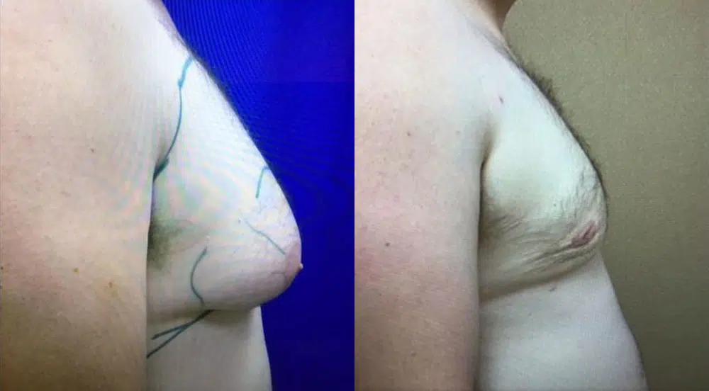 male gynecomastia before and after photo by chicago aesthetics surgery & med spa in chicago, il