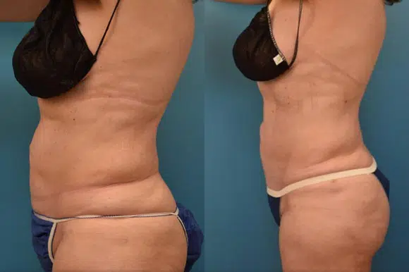 liposuction before and after photo by chicago aesthetics surgery & med spa in chicago, il