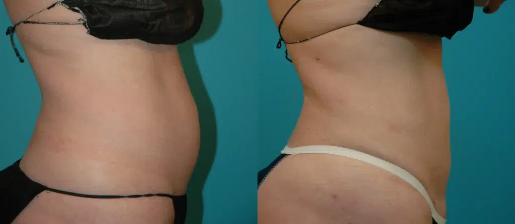 liposuction before and after photo by chicago aesthetics surgery & med spa in chicago, il
