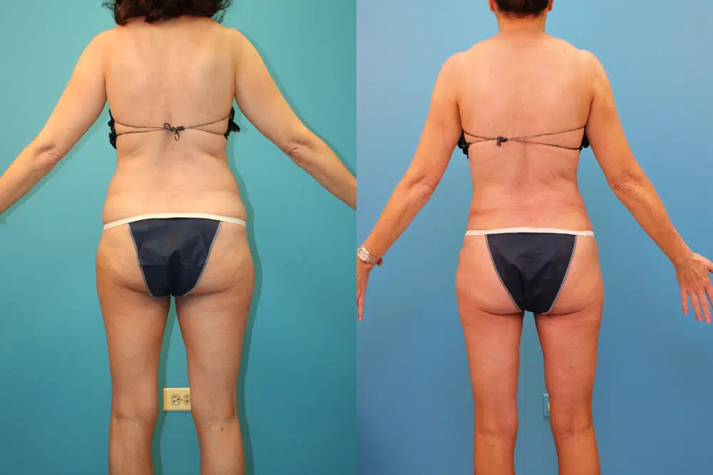 liposuction before and after photo by chicago aesthetics surgery & med spa in chicago, il