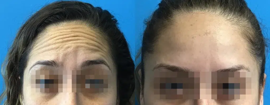botox® & dysport® before and after photo by chicago aesthetics surgery & med spa in chicago, il