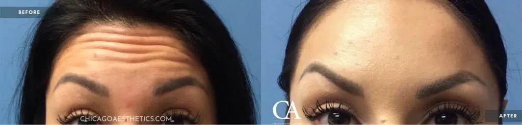 botox® & dysport® before and after photo by chicago aesthetics surgery & med spa in chicago, il