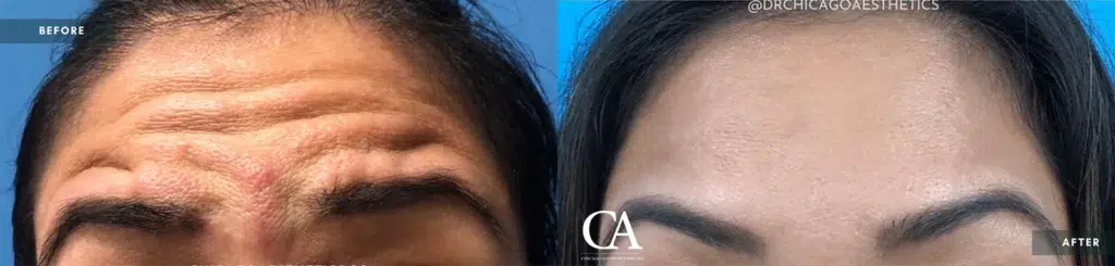 botox® & dysport® before and after photo by chicago aesthetics surgery & med spa in chicago, il