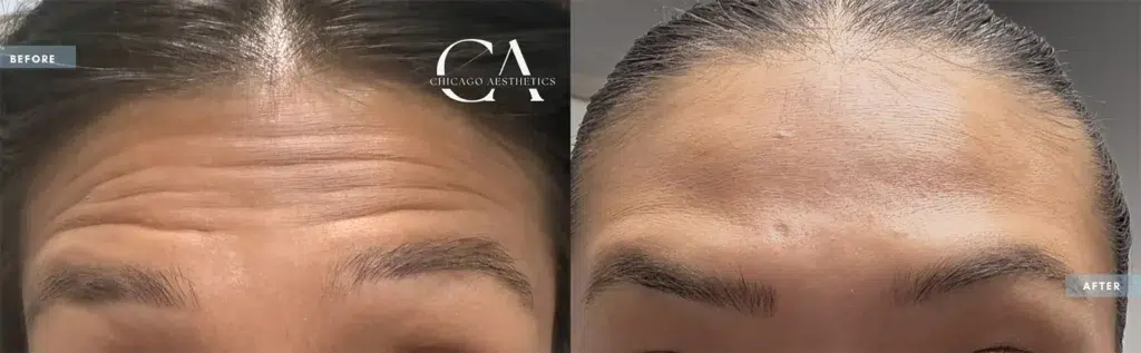 botox® & dysport® before and after photo by chicago aesthetics surgery & med spa in chicago, il