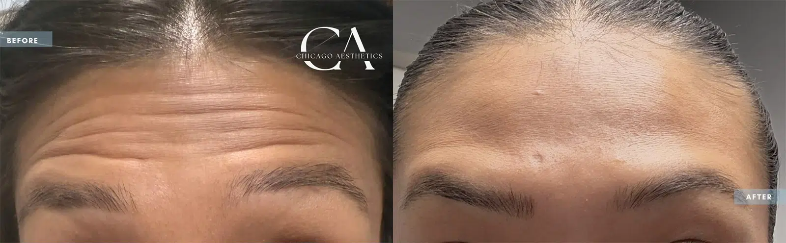 botox® & dysport® before and after photo by chicago aesthetics surgery & med spa in chicago, il