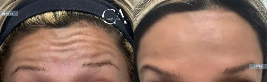 botox® & dysport® before and after photo by chicago aesthetics surgery & med spa in chicago, il