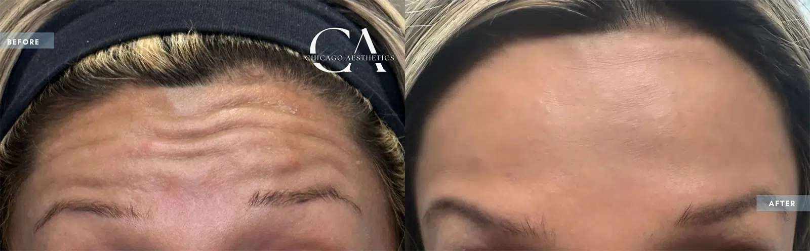 botox® & dysport® before and after photo by chicago aesthetics surgery & med spa in chicago, il