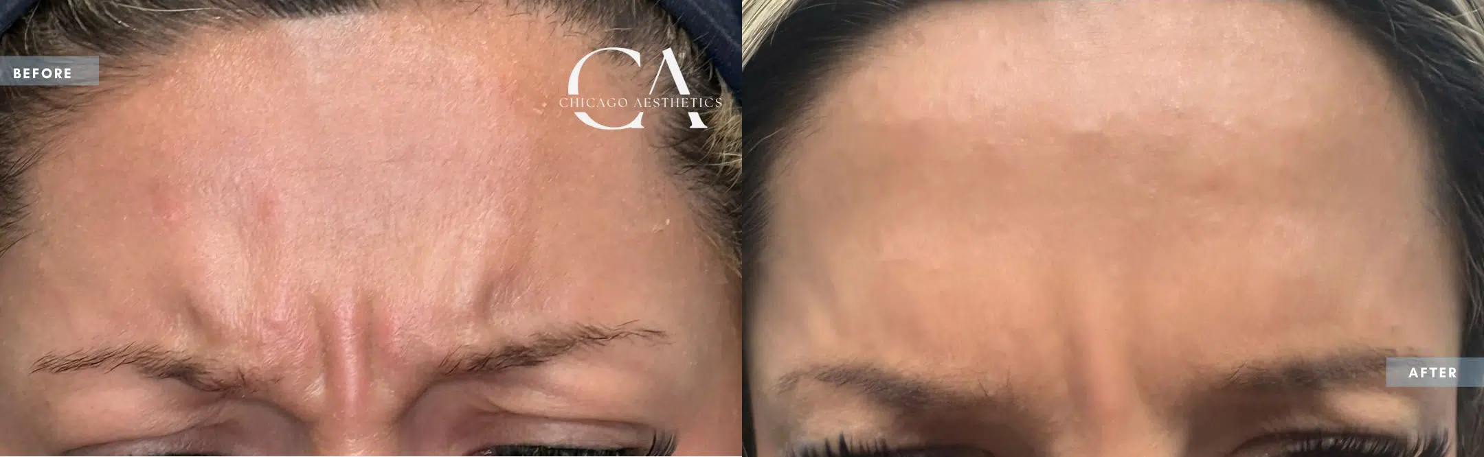 botox® & dysport® before and after photo by chicago aesthetics surgery & med spa in chicago, il