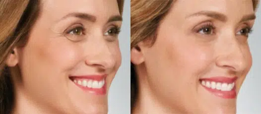 botox® & dysport® before and after photo by chicago aesthetics surgery & med spa in chicago, il