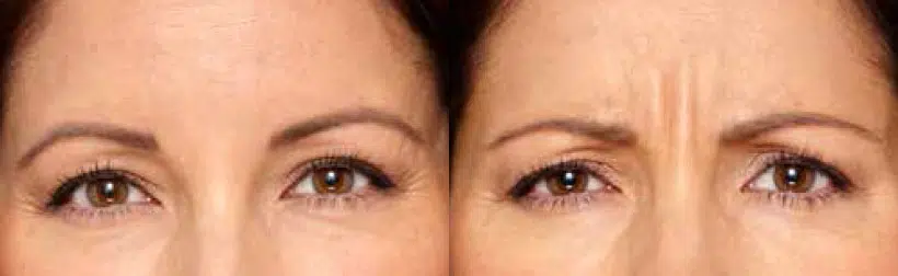 botox® & dysport® before and after photo by chicago aesthetics surgery & med spa in chicago, il