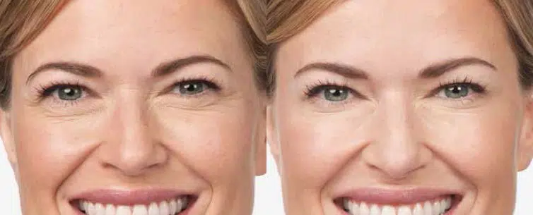 botox® & dysport® before and after photo by chicago aesthetics surgery & med spa in chicago, il