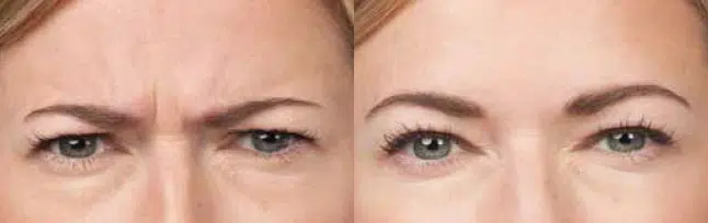 botox® & dysport® before and after photo by chicago aesthetics surgery & med spa in chicago, il