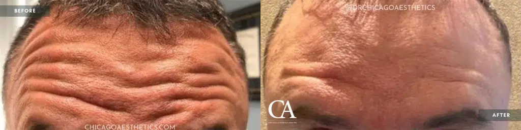 botox® & dysport® before and after photo by chicago aesthetics surgery & med spa in chicago, il