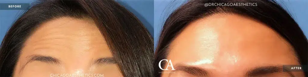 botox® & dysport® before and after photo by chicago aesthetics surgery & med spa in chicago, il
