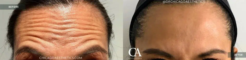 botox® & dysport® before and after photo by chicago aesthetics surgery & med spa in chicago, il