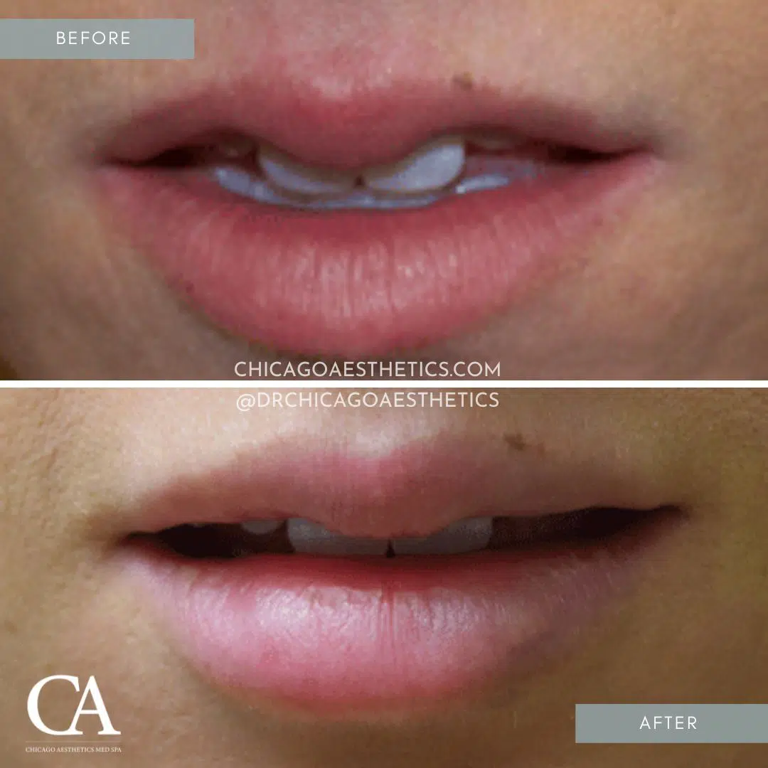lip filler before after chicago aesthetics