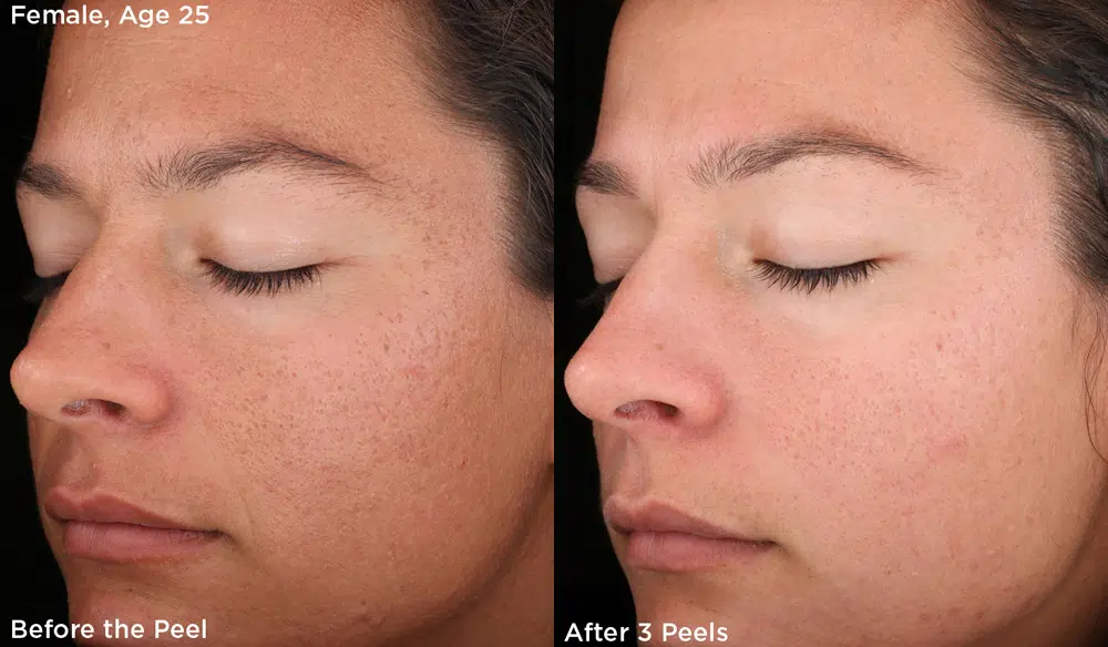 chemical peels before and after photo by chicago aesthetics surgery & med spa in chicago, il