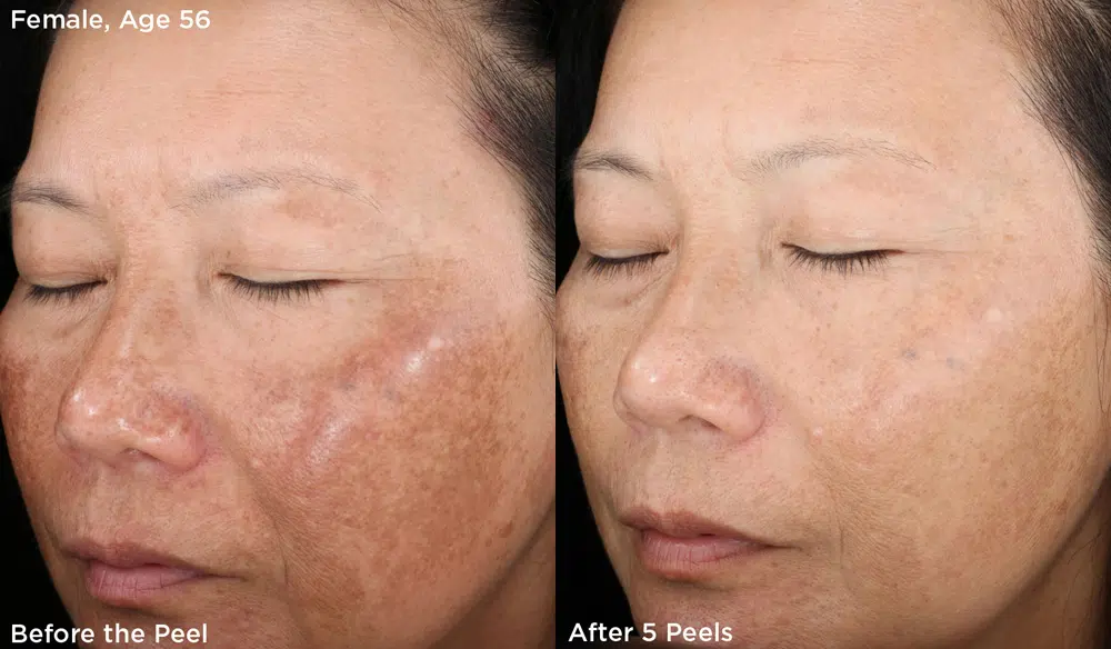 chemical peels before and after photo by chicago aesthetics surgery & med spa in chicago, il