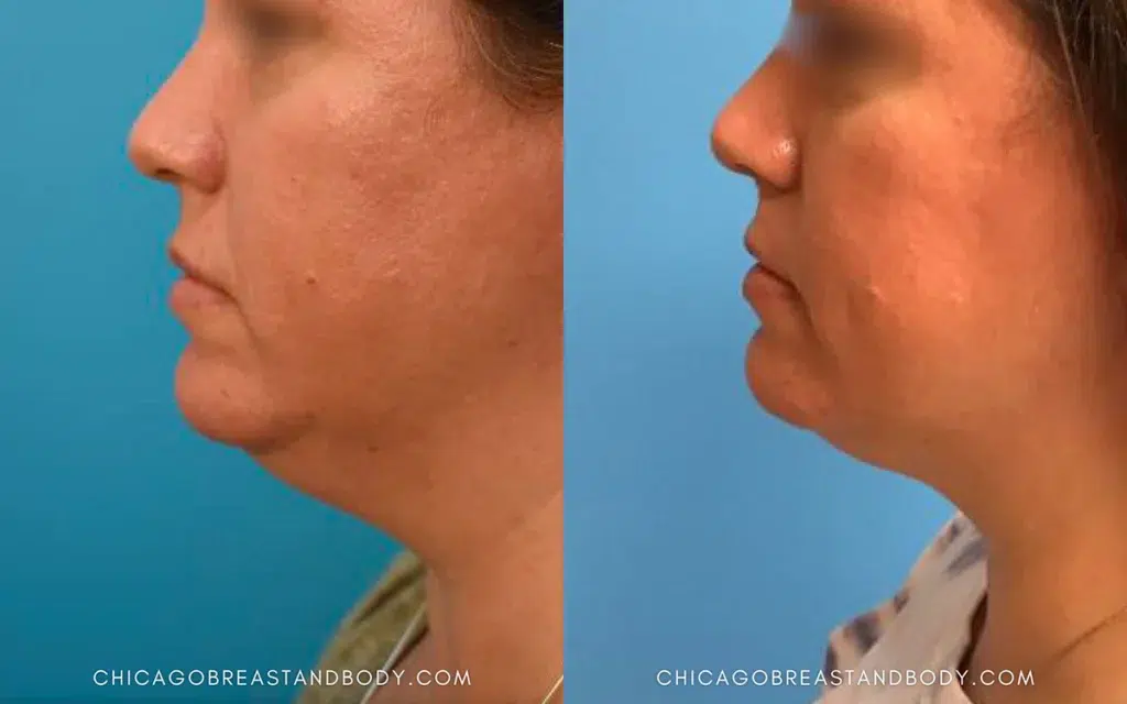chin & neck liposuction before and after photo by chicago aesthetics surgery & med spa in chicago, il