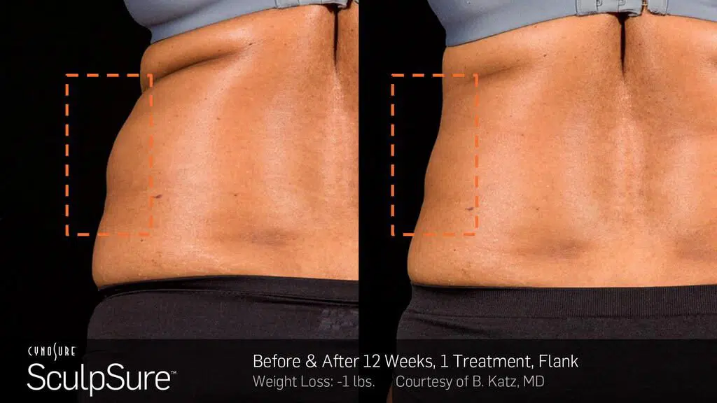 Sculpsure Before After Photos