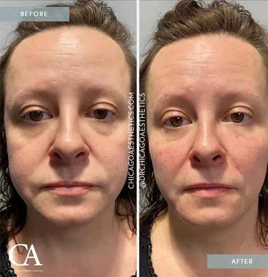 Before And After Photos Showcasing The Transformative Effects Of Dermal Fillers On A Woman'S Face.