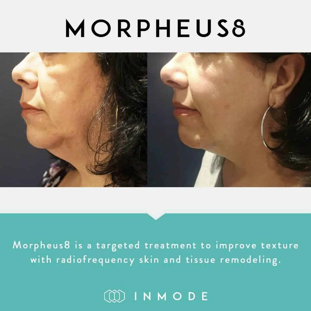 Morpheus8 Results