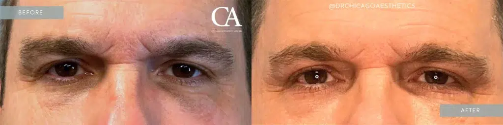 dermal fillers before and after photo by chicago aesthetics surgery & med spa in chicago, il