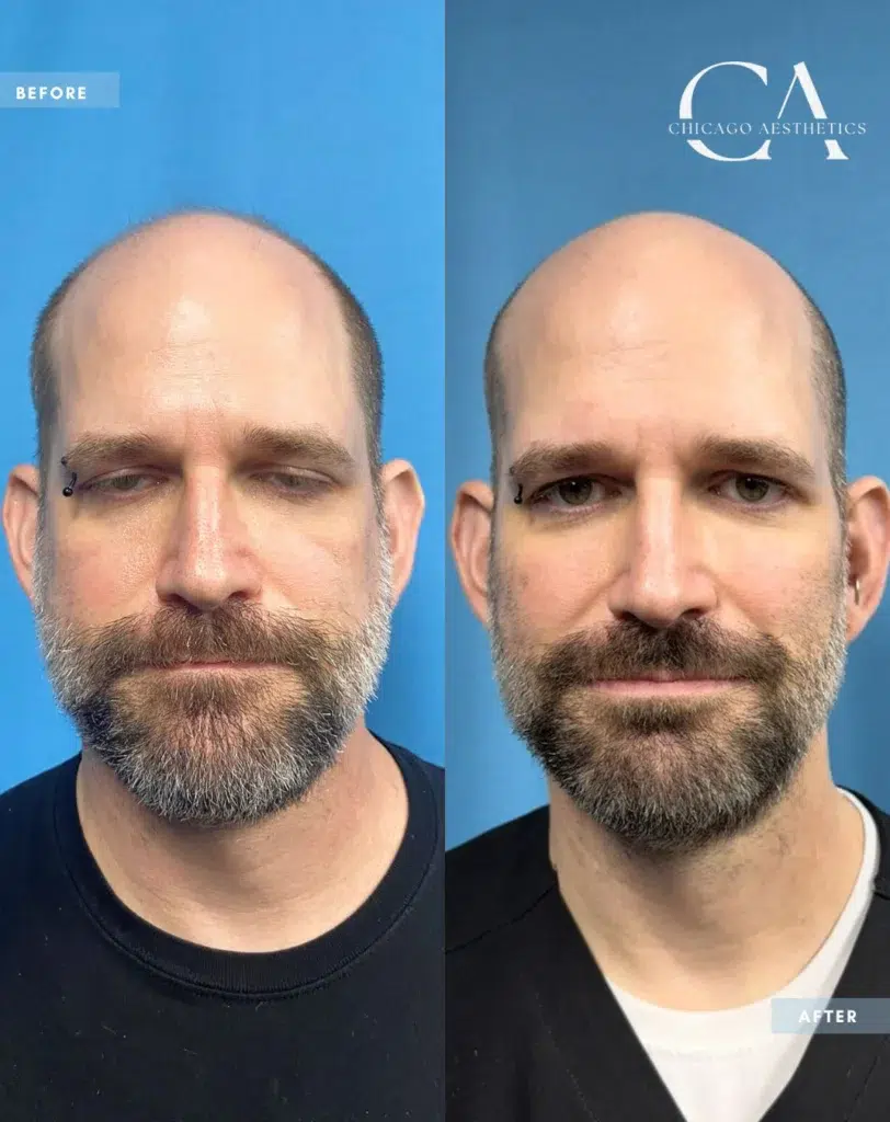 dermal fillers before and after photo by chicago aesthetics surgery & med spa in chicago, il