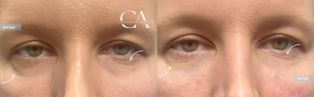 dermal fillers before and after photo by chicago aesthetics surgery & med spa in chicago, il