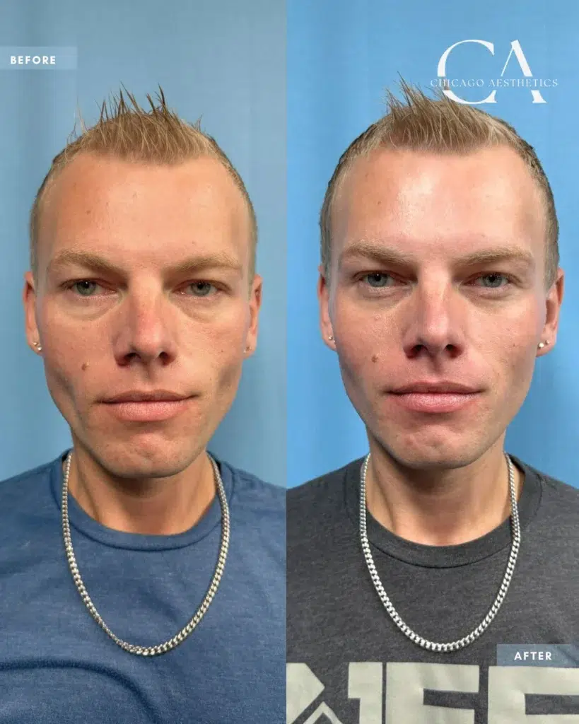dermal fillers before and after photo by chicago aesthetics surgery & med spa in chicago, il