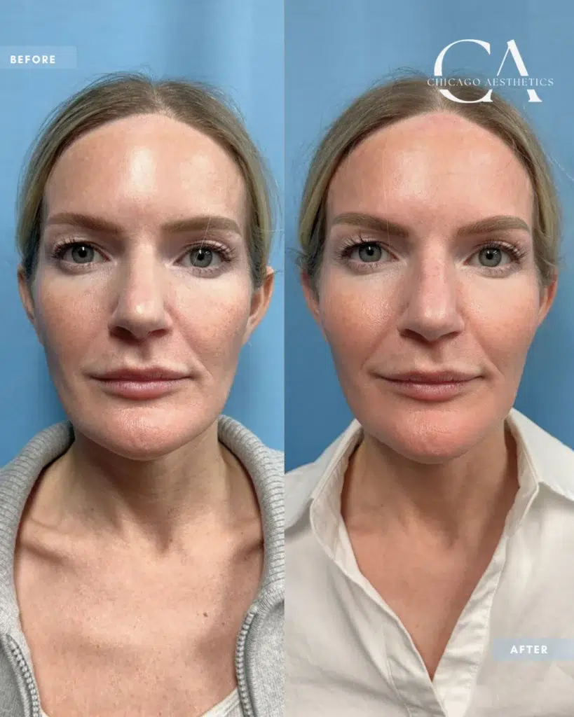dermal fillers before and after photo by chicago aesthetics surgery & med spa in chicago, il