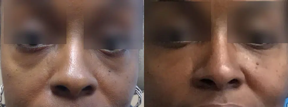 dermal fillers before and after photo by chicago aesthetics surgery & med spa in chicago, il