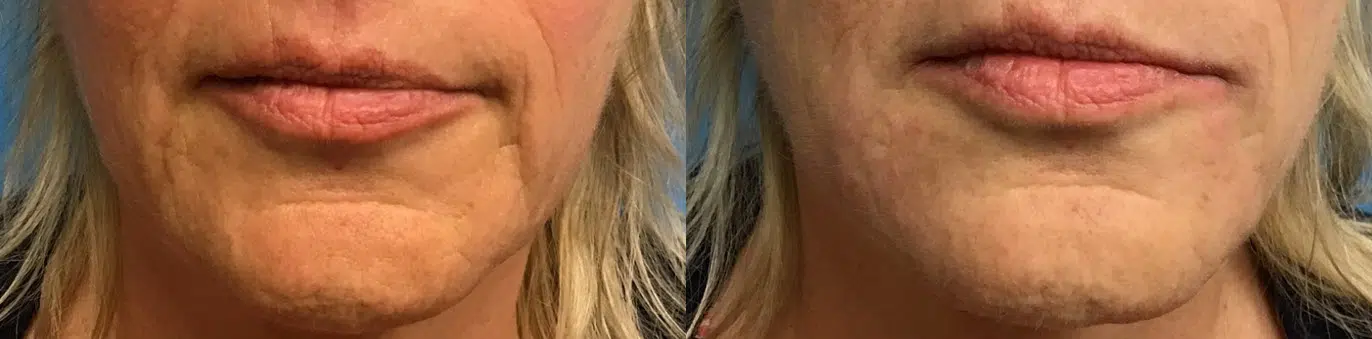 dermal fillers before and after photo by chicago aesthetics surgery & med spa in chicago, il