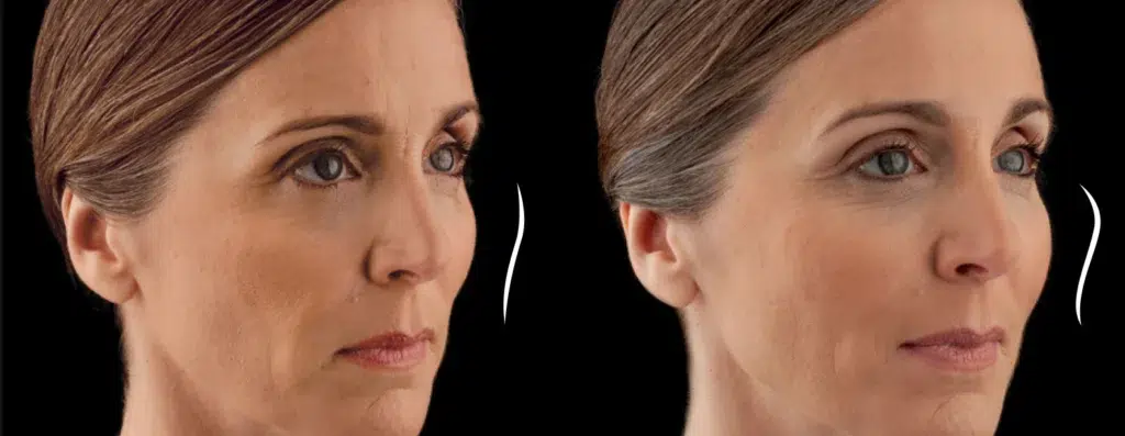 dermal fillers before and after photo by chicago aesthetics surgery & med spa in chicago, il