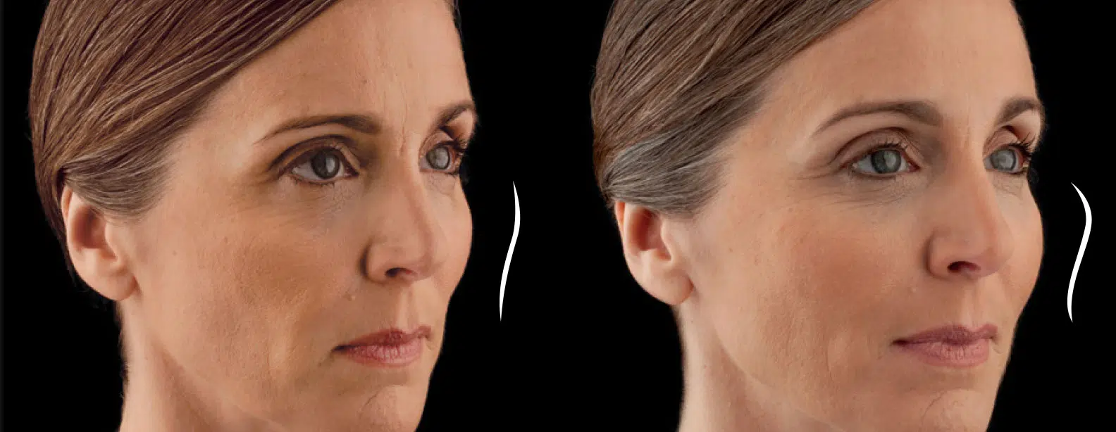 dermal fillers before and after photo by chicago aesthetics surgery & med spa in chicago, il