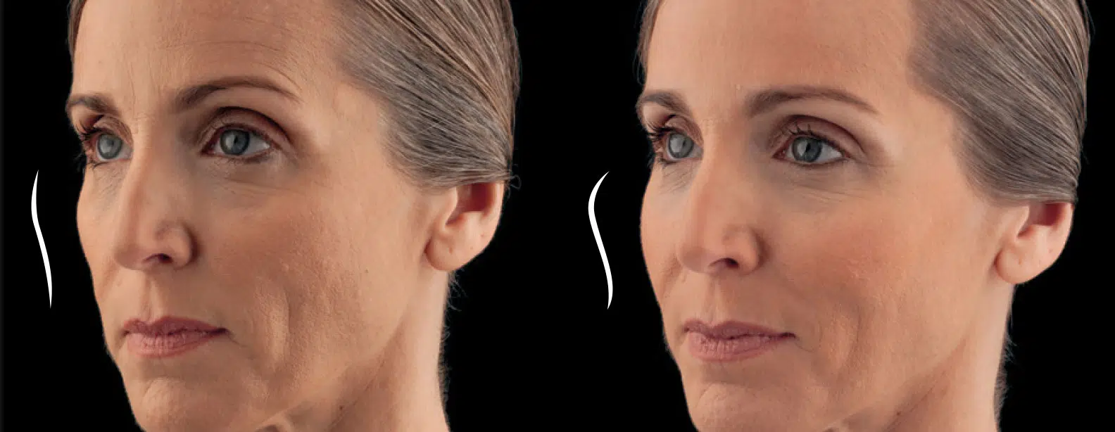 dermal fillers before and after photo by chicago aesthetics surgery & med spa in chicago, il