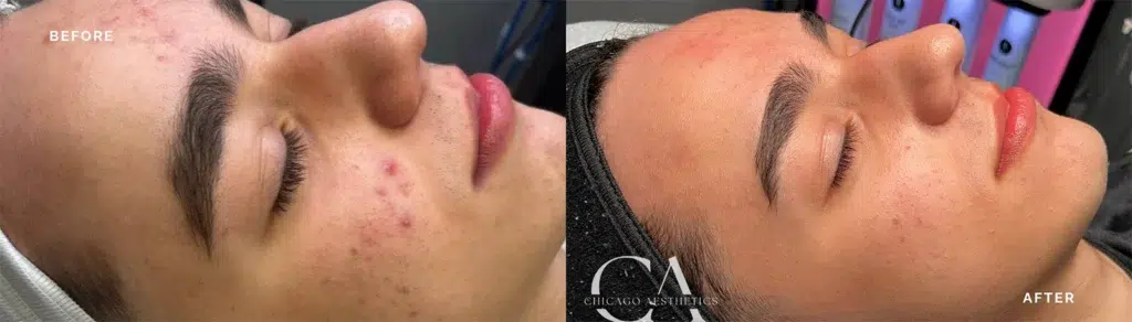 hydrafacial before and after photo by chicago aesthetics surgery & med spa in chicago, il