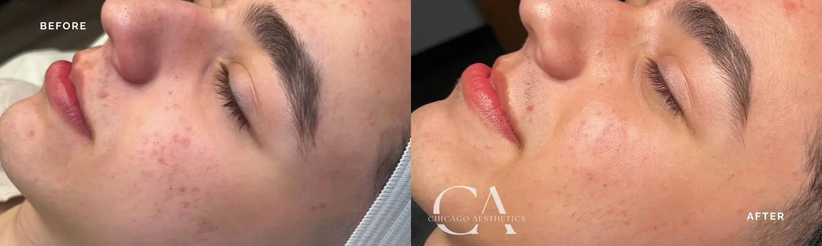 hydrafacial before and after photo by chicago aesthetics surgery & med spa in chicago, il