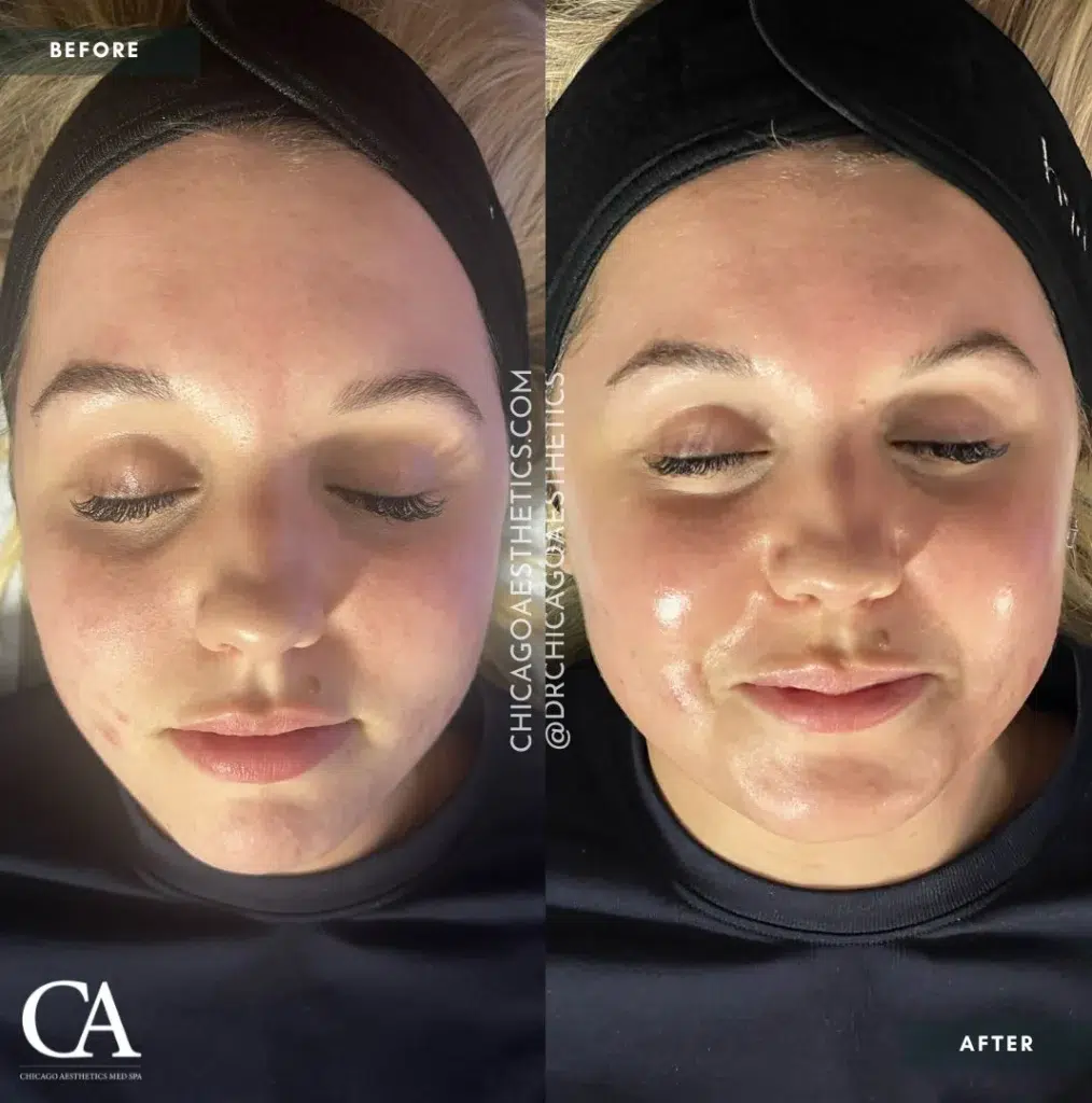 hydrafacial before and after photo by chicago aesthetics surgery & med spa in chicago, il