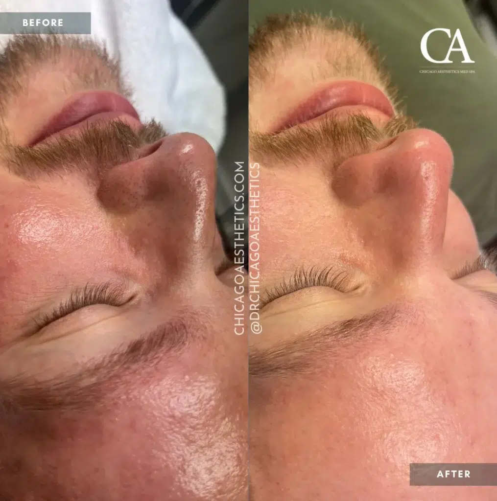 hydrafacial before and after photo by chicago aesthetics surgery & med spa in chicago, il