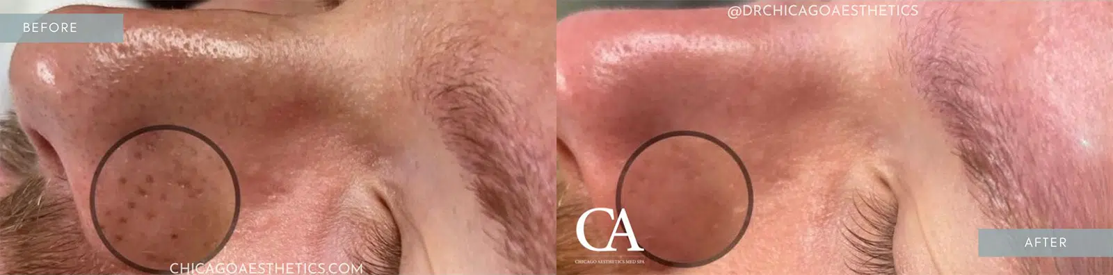 hydrafacial before and after photo by chicago aesthetics surgery & med spa in chicago, il