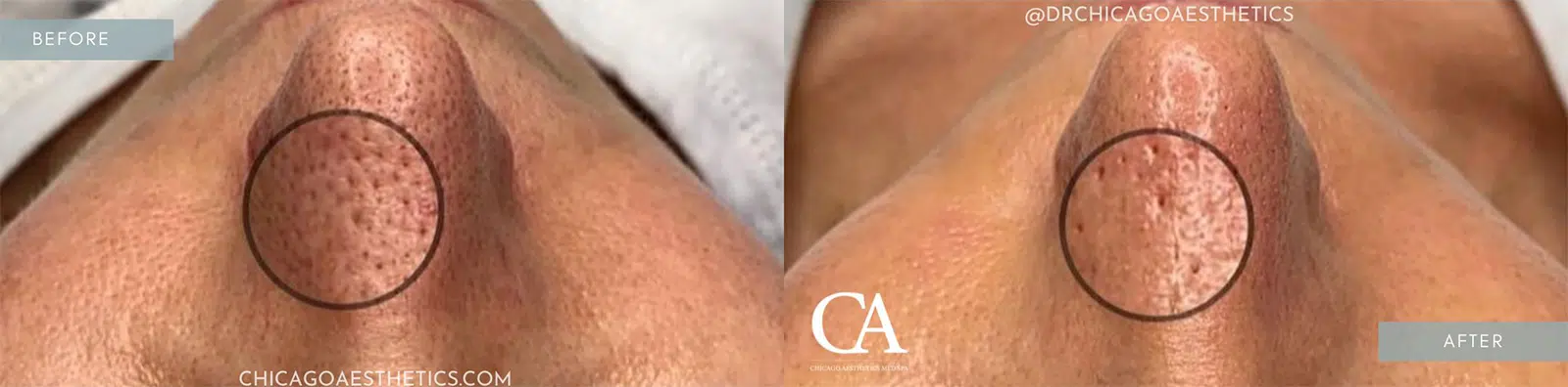 hydrafacial before and after photo by chicago aesthetics surgery & med spa in chicago, il