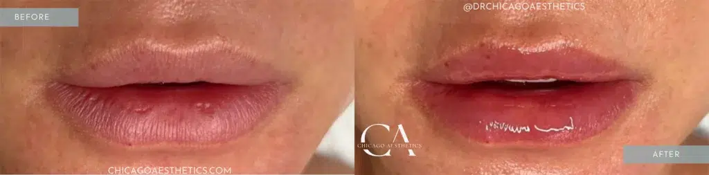 hydrafacial before and after photo by chicago aesthetics surgery & med spa in chicago, il