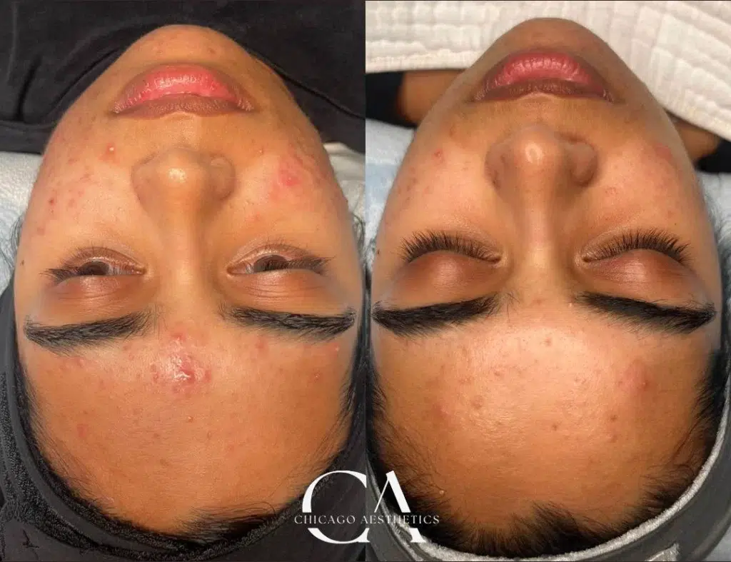 hydrafacial before and after photo by chicago aesthetics surgery & med spa in chicago, il