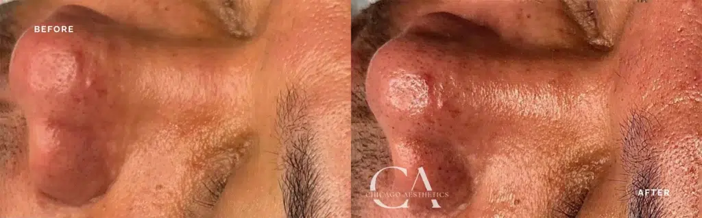 hydrafacial before and after photo by chicago aesthetics surgery & med spa in chicago, il