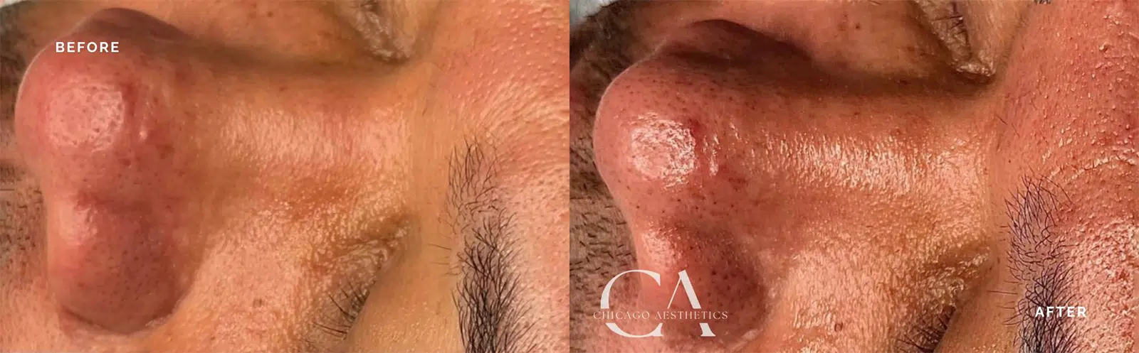 hydrafacial before and after photo by chicago aesthetics surgery & med spa in chicago, il