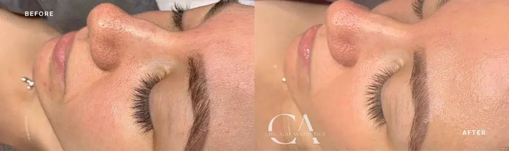hydrafacial before and after photo by chicago aesthetics surgery & med spa in chicago, il