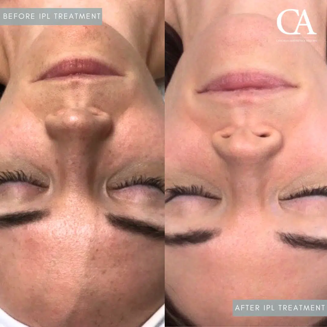 ipl treatment before and after photo by chicago aesthetics surgery & med spa in chicago, il