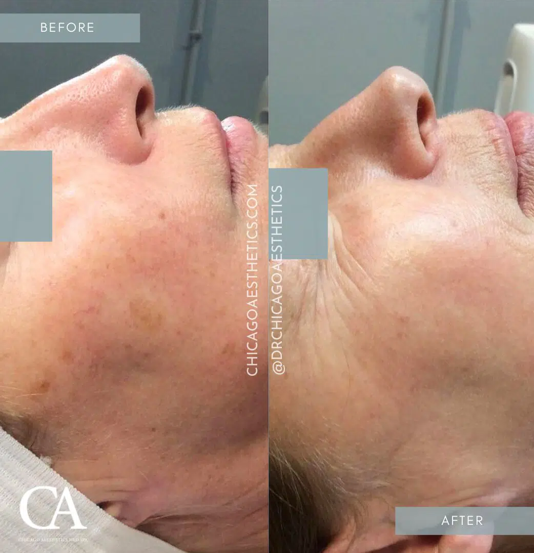 ipl treatment before and after photo by chicago aesthetics surgery & med spa in chicago, il